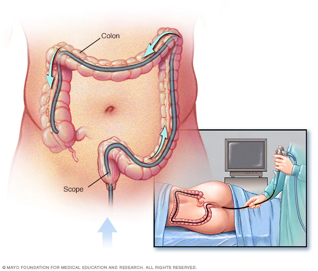 What Is Colonoscopy ? What Happens During A Colonoscopy?