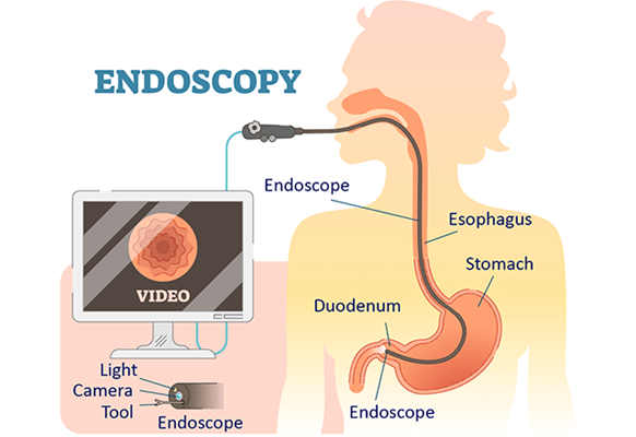 What Is Endoscopy ? Why Do I Need An Endoscopy?