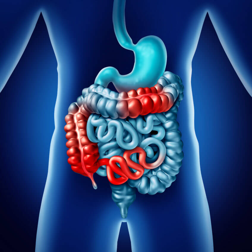  Crohn's Disease | causes | symptoms | treatment