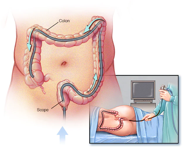 Colonoscopy