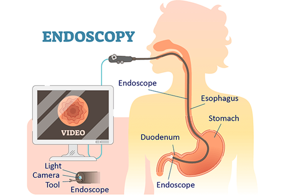 Endoscopy