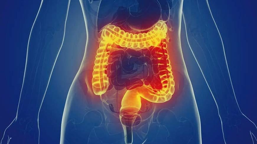 diverticular