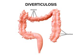 Diverticular